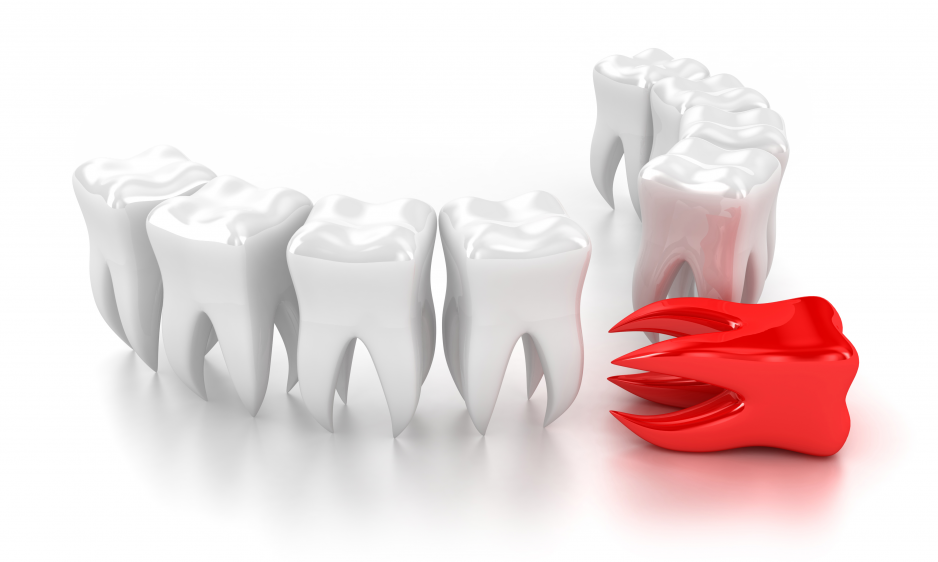 Удаление зуба любой сложности в Одинцово. Стоимость удаления верхних и нижних зубов - стоматология «СК-Мед»