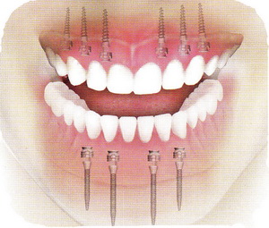 Фото имплантов зубов

