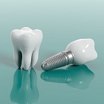 Сколько стоит зубной имплант