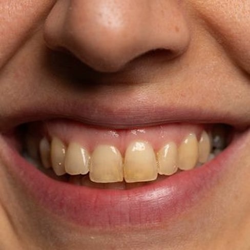 Как и почему темнеют зубы: в чем причина утраты белоснежной улыбки?