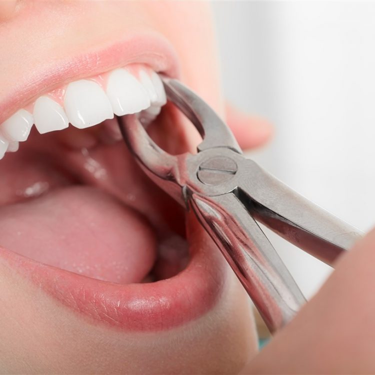 Сколько заживают десны при удалении зубов