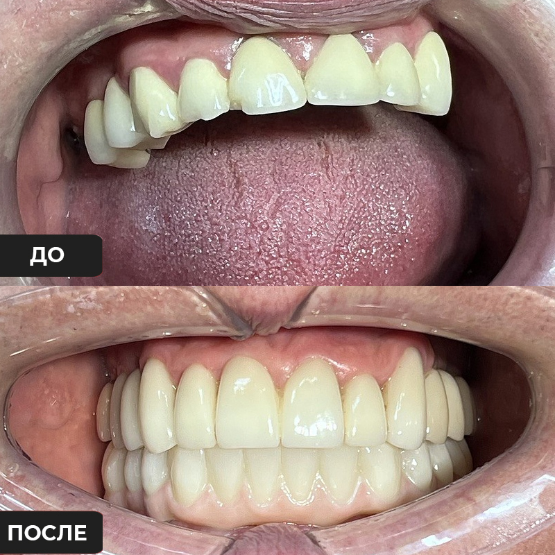 Реставрация зубов, фото до/после