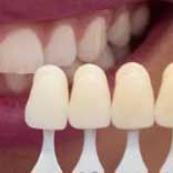 Выбор зубного протеза