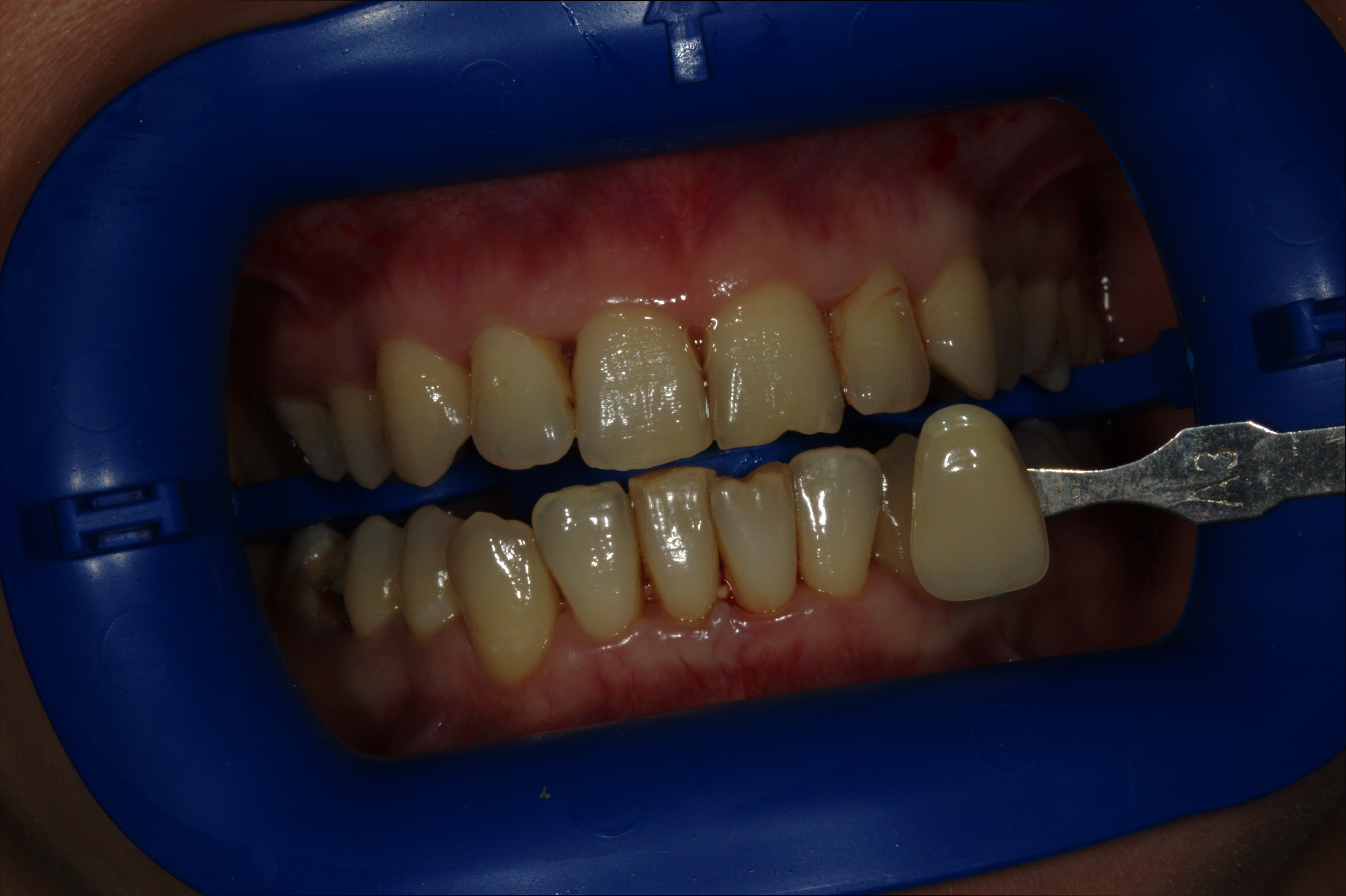 Отбеливание зубов у стоматолога