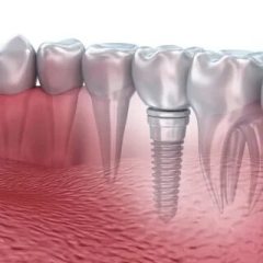 Частые вопросы по имплантации зубов